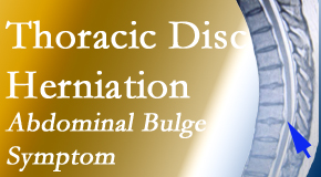New Roads Chiropractic Center cares for thoracic disc herniation that for some patients prompts abdominal pain.