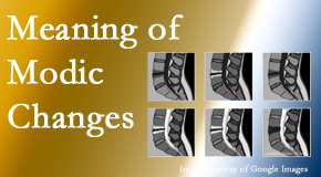 New Roads Chiropractic Center sees many back pain and neck pain patients who bring their MRIs with them to the office. Modic changes are often noted. 