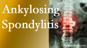 Ankylosing spondylitis is gently cared for by your New Roads chiropractor.