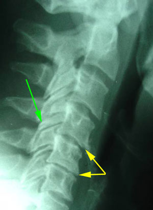 disc degeneration treated at New Roads Chiropractic Center