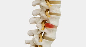 New Roads chiropractic conservative care helps even huge disc herniations go away