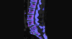 New Roads Chiropractic Center is aware that inflammatory spinal gout is a differential diagnosis to consider for patients who present with back pain and other spine related symptoms.