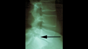 New Roads spondylolisthesis 