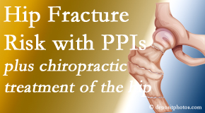 New Roads Chiropractic Center shares new research describing higher risk of hip fracture with proton pump inhibitor use. 