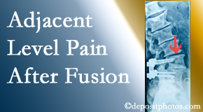 New Roads Chiropractic Center offers relieving care non-surgically to back pain patients experiencing adjacent level pain after spinal fusion surgery.