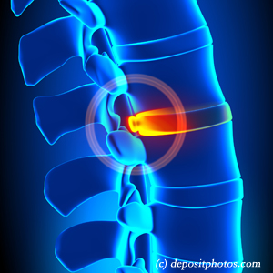 image of lumbar New Roads disc herniation