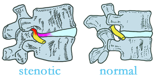 New Roads stenotic and normal spinal discs